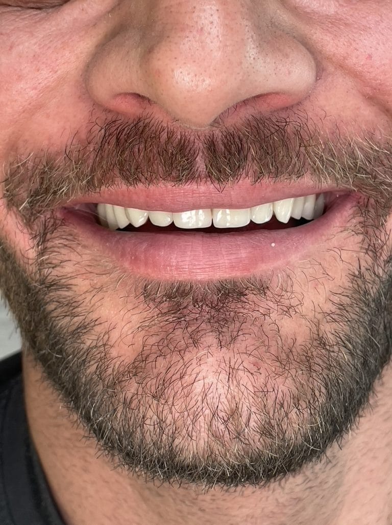 résultat implant dentaire